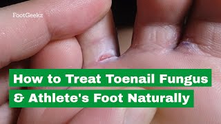 How to Treat Toenail Fungus amp Athletes Foot Naturally [upl. by Shaina]