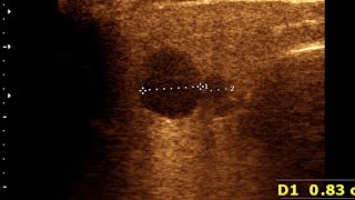 Parotitis  Lymphadenitis  Normal Thyroid Gland [upl. by Dressler]