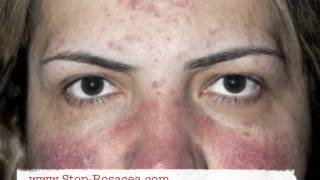 Rosacea Pictures [upl. by Natalya311]