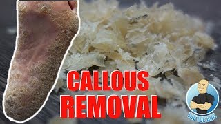 REMOVING EXTREMELY HARD FOOT CALLUS  CALLOUS FOOT [upl. by Keldon815]