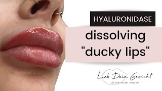 Dissolving Lip Filler [upl. by Lavinie]