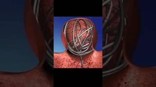 Brain aneurysm non surgery treatment  coiling  Dr Dharav  Mumbai coiling brainaneurysm [upl. by Corrine699]