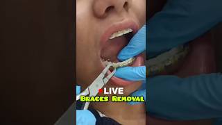 LIVE Braces Removal Dr Srishti Bhatia braces teeth smile [upl. by Yelbmik507]