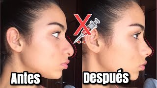 RINOPLASTIA CASERA EN MINUTOS  RESPINGADORES PARA NARIZ BONITA [upl. by Aihsit332]