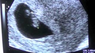 Pregnancy Vlog Week 7 First Ultrasound [upl. by Arny580]