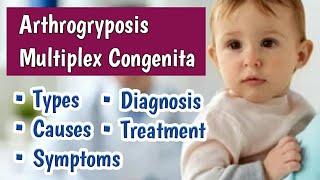 Arthrogryposis Multiplex Congenita AMC  Multiple Newborn Joint Contractures at Birth [upl. by Habeh]