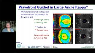 Laser Eye Surgery Topography or WavefrontGuided TransPRK Vs LASIK Vs SMILE Vs ICL [upl. by Cohdwell984]