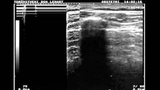 Normal lung vs pneumothorax [upl. by Amrak744]