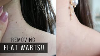 FINALLY REMOVING FLAT WARTS OMG [upl. by Annice]