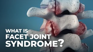 What is Facet Joint Syndrome AtlanticSpineCenter [upl. by Acimahs]