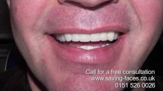 missing teeth in liverpool dental bridges liverpool  saving faces [upl. by Laura]