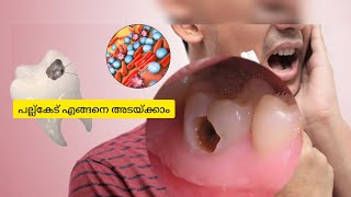 പല്ല്കേട് എങ്ങനെ അടയ്ക്കാം toothdecay [upl. by Punke588]