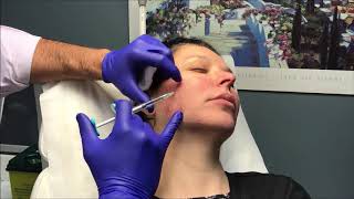 Dr Nino Kuzmar Injects Juvederm Volite SKIN BOOSTER [upl. by Tnecnev472]