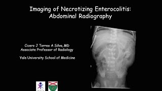 Necrotizing enterocolitis [upl. by Sorensen]