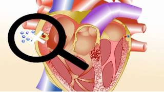 Angina pectoris  Symptomen en behandeling bij pijn op de borst [upl. by Ajar968]