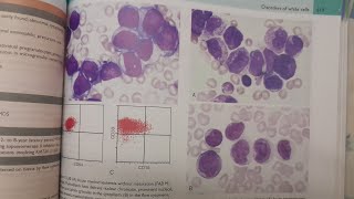 Acute Myeloid Leukemia  SPECIAL PATHOLOGY [upl. by Achilles]