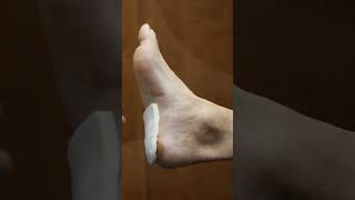 Retrocalcaneal Bursitis Treatment for Heel Bone Pain  Ankle amp Foot Centers of America shorts [upl. by Kitty]