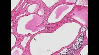 Histopathology NeckLymphangioma cystic hygroma [upl. by Kletter876]