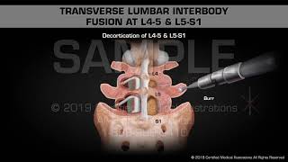 Open Spinal Decompression at Left L34 amp L45 [upl. by Arbma]