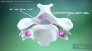 Cervical Osteochondrosis Definition [upl. by Nesbitt872]