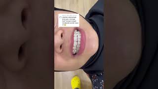 3 Types of Teeth Retainers  Clear Hawley amp Permanent Retainer [upl. by Ayotnahs277]