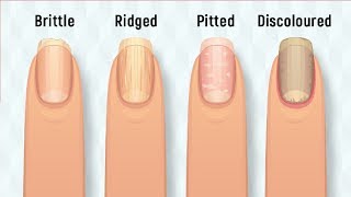 8 Things Your Nails Can Say About Your Health [upl. by Yaf]