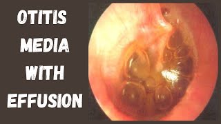 Otitis Media With Effusion OME  Glue Ear [upl. by Sherrard]