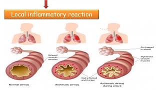 MED LEVEL2 RES LECTURE2 LOEFFLER’S SYNDROME amp VLM [upl. by Tomasina]