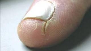 DermTV  How to Heal Cracked Fingertips DermTVcom Epi 125 [upl. by Jacobah]