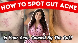 6 Gut Acne Signs amp Symptoms The Gut Acne Connection amp How To Heal Your Gut Acne [upl. by Ipoillak694]