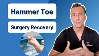 How Long Is Recovery From Hammer Toe Surgery [upl. by Kelbee]