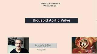 Bicuspid Aortic Valve [upl. by Lladnew]