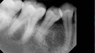 Is there a radiolucent lesion [upl. by Ottillia360]