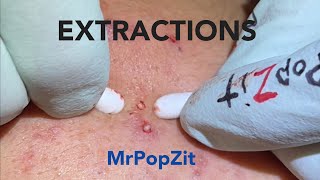 Extractions Blackheads for days 4 Whiteheads milia acne cysts popped 75 improved [upl. by Dugas]