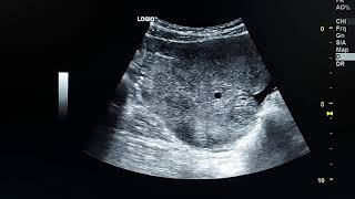 ovarian torsion ultrasound case [upl. by Eichman945]