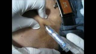 How To Give Goserelin Injection By Subcutaneous Mode [upl. by Arriaet]