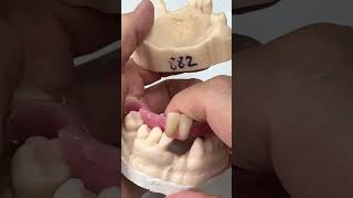 Patient will get new denture also lower flipper EnvisiontecMain envisiontec [upl. by Tingley477]