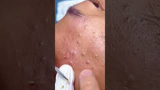 Huge Blackhead Extraction Extremely Satisfying [upl. by Eirovi158]