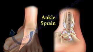 Ankle Pain ankle ligaments sprain  Everything You Need To Know  Dr Nabil Ebraheim [upl. by Anerok]