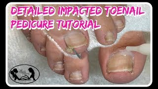 Satisfying Impacted Toenail Cleaning Pedicure Tutorial Detailed Instruction ⭐ [upl. by Sidwohl]