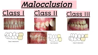 malocclusionsClass IClass IIClass IIIClinical featuresQuick Revision [upl. by Naginarb]