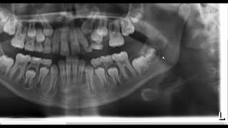 4th molar or pathology or normal anatomy [upl. by Hapte]