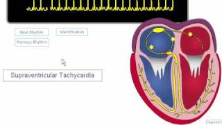 ECG Rhythm Review SVT Atrial Fibrillation Atrial Flutter [upl. by Flossi]