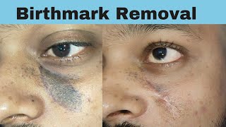 Birthmark Removal Birthmark Removal with surgery  laser treatment by Dr Pankaj Kumar [upl. by Scheld]