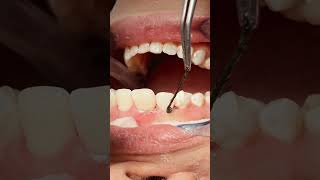 Retraction cord removal after composite veneer dentist dentalprocedure satisfying [upl. by Henn310]