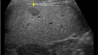 Hepatic mass Splenomegaly Ascites Hepatomegaly Hydatid cyst Hepatic Hydatid cyst [upl. by Lebbie732]