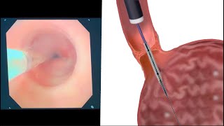 Schatzkis Ring Endoscopic Balloon Dilation to Improve Swallowing [upl. by Adia]