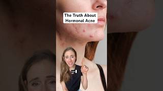 Hormonal Acne Is A Mixed Bag  Heres What You Need To Know dermatologist [upl. by Zielsdorf234]