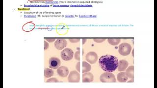 Sideroblastic AnemiaMicrocytic Anemia [upl. by Elocal772]