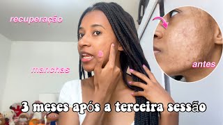 Atualização sobre a terceira sessão do tratamento Refine Skin [upl. by Walther]